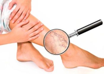 Варикоз тукум кууйбу?