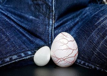 Варикоцелеге операция жасаткам