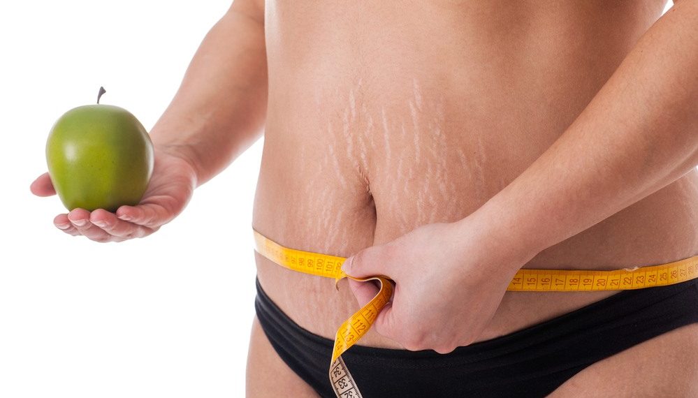 Төрөттөн кийинки ичимдеги “растяжканы” кантип кетирем? Косметолог жооп берет