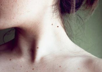 Бетимдеги калдар көбөйө баштады. Эмне кылам?