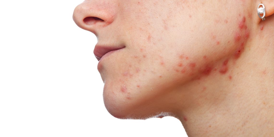 Турмушка чыксам безеткиден арыламбы?