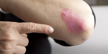 Псориаз деген кандай оору? Дерматолог айтып берет