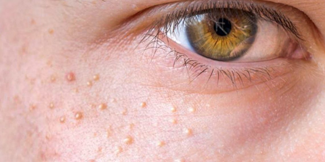 Көзүмдүн айланасына ак угрилер чыгып кетти