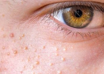 Көзүмдүн айланасына ак угрилер чыгып кетти