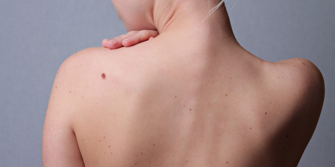 Денемде калдар көп. Аларды кантип кетирсем болот? Косметолог жооп берет