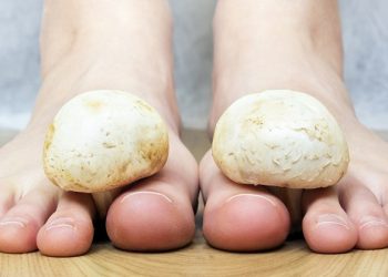 Бутума «грибок» жугузуп алдым. Кандай чара көрсөм болот? Дерматолог жооп берет