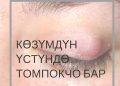 Көзүмдүн үстүндө шишик бар