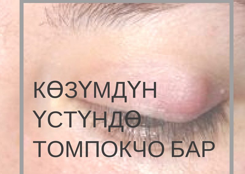 Көзүмдүн үстүндө шишик бар