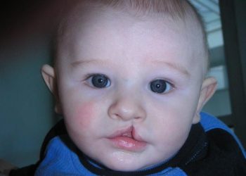 Нишаны менен төрөлгөн балдарга операция акысыз жасалабы? Дарыгер жооп берет