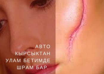 Авто кырсыктан улам бетимде шрам бар