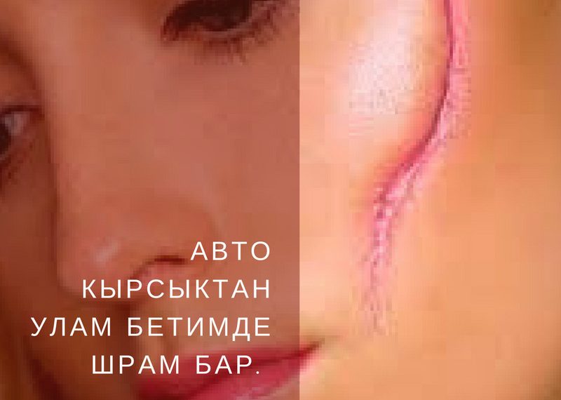 Авто кырсыктан улам бетимде шрам бар