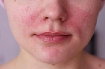 Синафлан бетке зыян эмеспи?