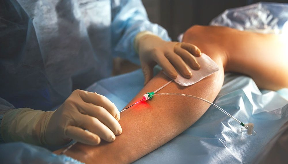 Лазер менен варикозду жок кылуу канча турат? Флеболог жооп берет