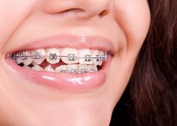 Брекет салынган тиштерим кайра кыйшыйып калбайбы? Стоматолог жооп берет