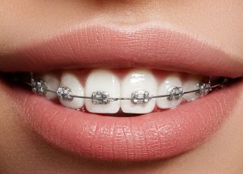 Кош бойлуу болгондо тишке брекет койдурса болобу? Стоматолог жооп берет