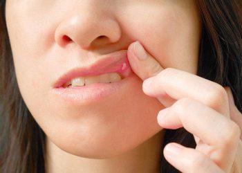 Осул (стоматит) - белгилери