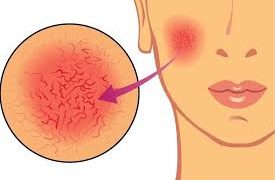 Бетимдеги кызыл тамырчалардан уялам