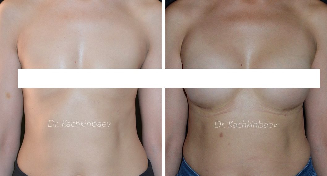 Төштү чоңойтуу эми көйгөй эмес