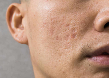 Безеткиден калган тырыкты кантип кетирсе болот? Косметолог жооп берет