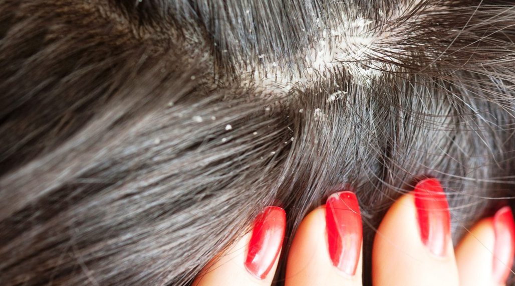 Какачтан кантип арылам? Трихолог жооп берет