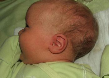 Баламдын бир кулагы жабык. Эми укпай калабы?