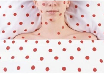 “Ветрянка” болуп ооруп калдым. Коркунучтуу эмеспи? Дарыгер жооп берет