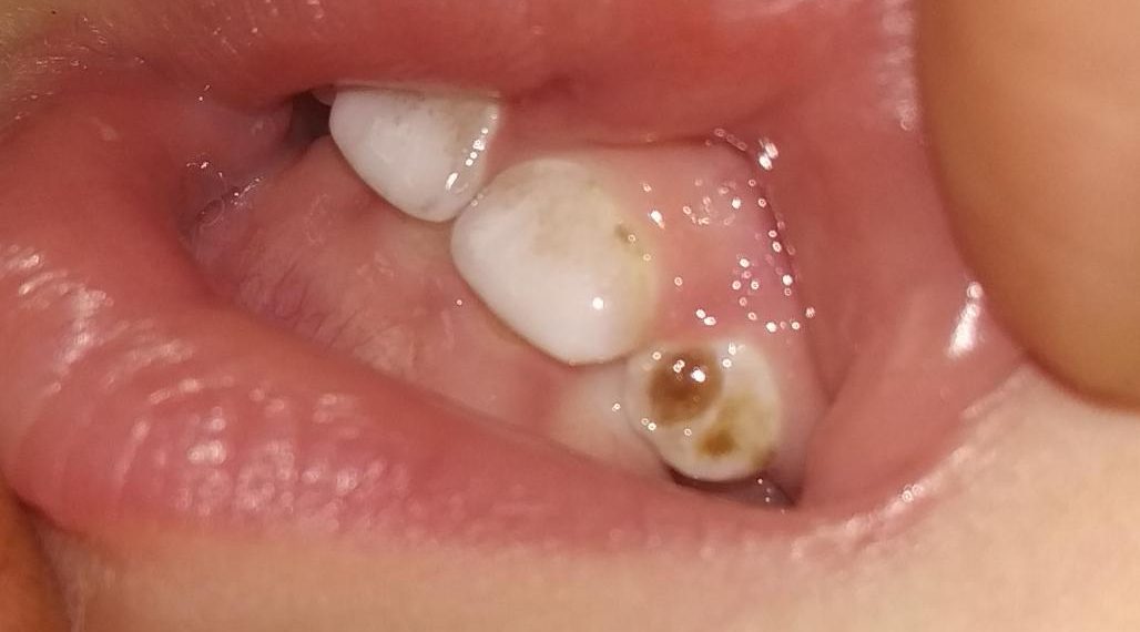 Бир жарым жаштагы баламдын тиши карарып кетсе эч нерсе болбойбу?