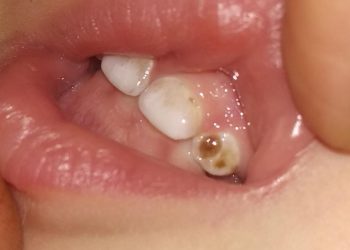 Бир жарым жаштагы баламдын тиши карарып кетсе эч нерсе болбойбу?