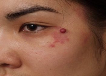 Бетимдеги анарды кантип жок кылсам болот? Онкодерматолог жооп берет