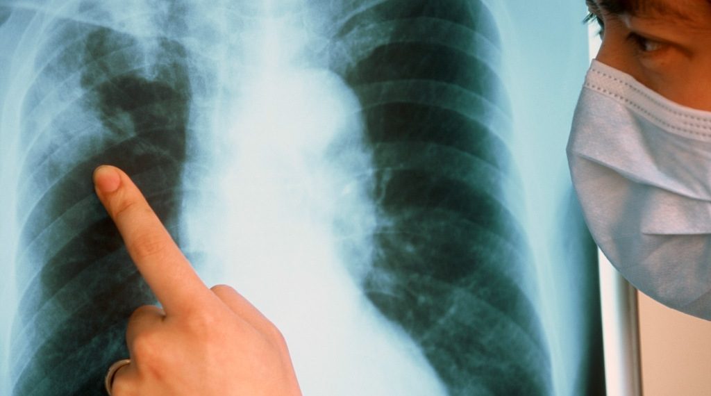 “Туберкулез” менен ооругам