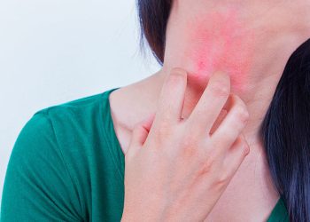 Күн тийгенде денем кызарып