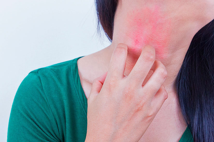 Күн тийгенде денем кызарып