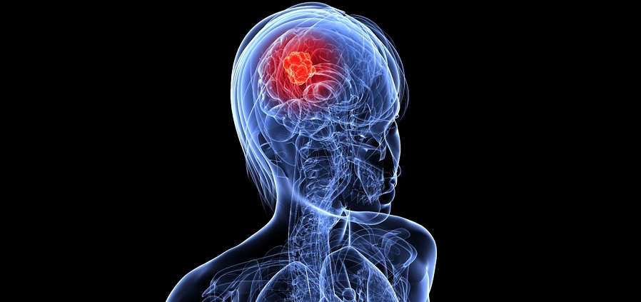 Башында “опухоль” болсо мээси айнып калат деген чынбы? Адистин жообу