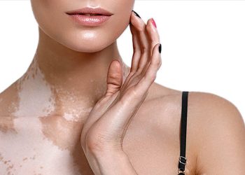 Алапес оорусунан кантип арылам? Дерматолог жооп берет