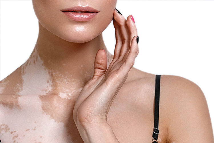 Алапес оорусунан кантип арылам? Дерматолог жооп берет