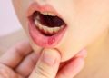 Үч жаштагы кызым көп стоматит боло берет