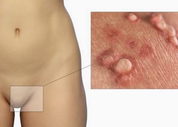 Адамдын папиллома вирусу тууралуу сөзсүз билүү керек болгон фактылар