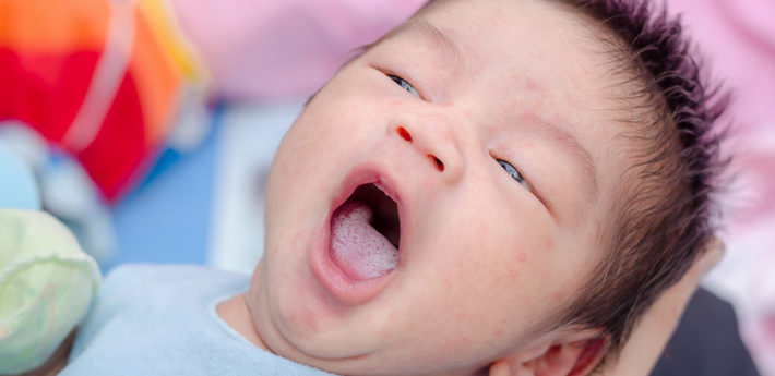 Төрт айлык баламдын оозу агарып кетпей жатат. Эмне кылсам болот?