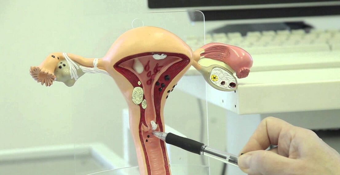 Эрозиянын күйгүзгөндөн кийин канча убакытта айыгат?