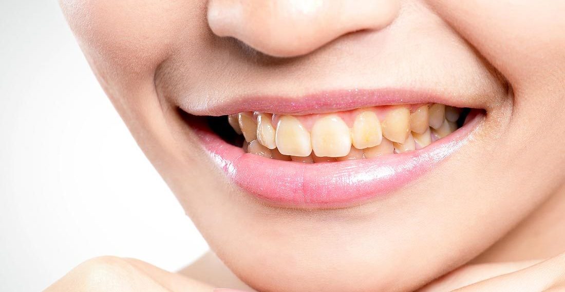 Тиштин саргарып кетүүсүнүн себептери