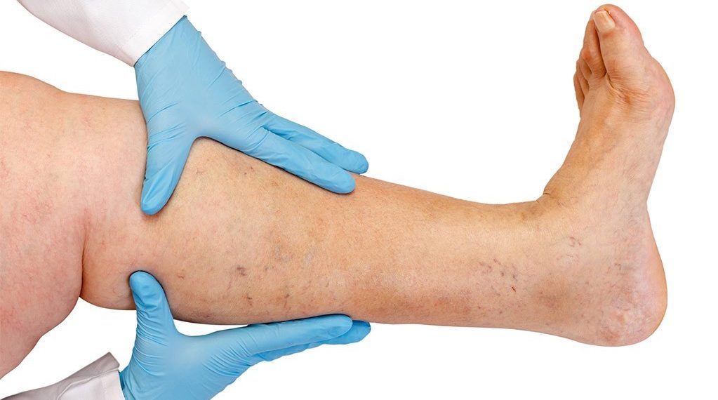 Варикоз тууралуу кызыктуу 7 факт. Флеболог айтып берет