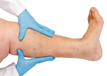 Варикоз тууралуу кызыктуу 7 факт. Флеболог айтып берет