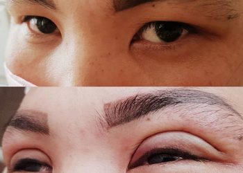 Сингапури менен блефаропластиканын айырмасы эмнеде? Хирург айтып берет