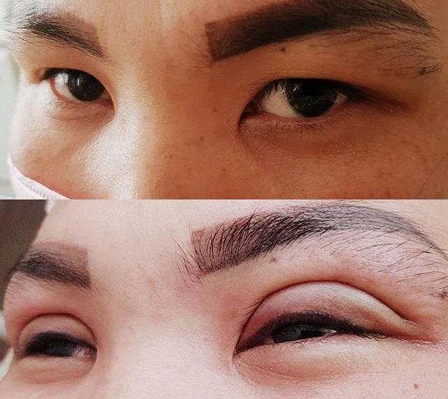 Сингапури менен блефаропластиканын айырмасы эмнеде? Хирург айтып берет