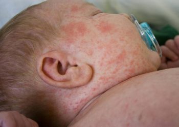 Балдардын аллергиясын пайда кылган азыктар. Педиатрдын кеңеши