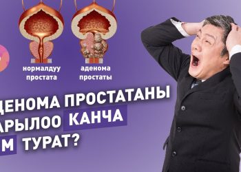 Простата аденомасы деген эмне жана аны кантип дарыласа болот?
