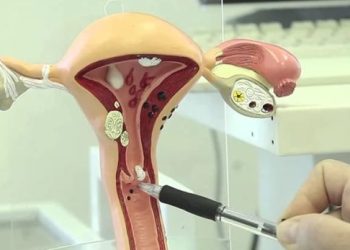 “CIN 1 дисплазия” диагнозу менен төрөй аламбы?