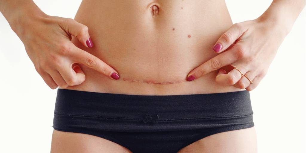 Кесарево жолу менен төрөгөндөн кийин сол энелик безим ооруп калды. Эмнеге?