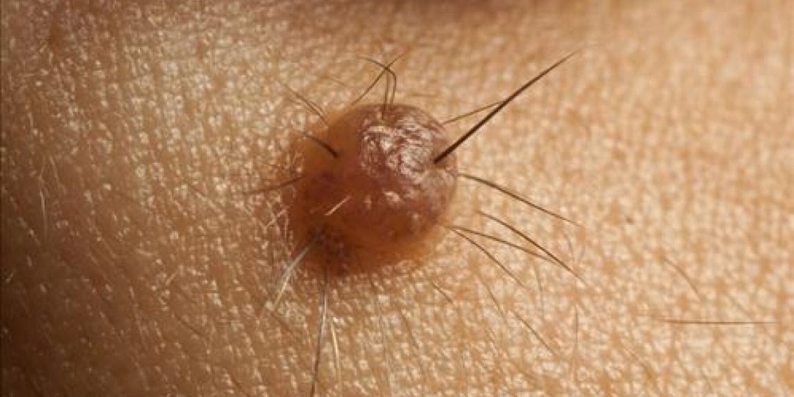 Эмнеге калдын ортосунан чач чыгып каларын онколог айтып берет