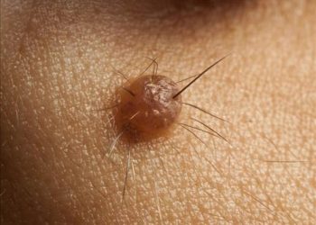 Эмнеге калдын ортосунан чач чыгып каларын онколог айтып берет